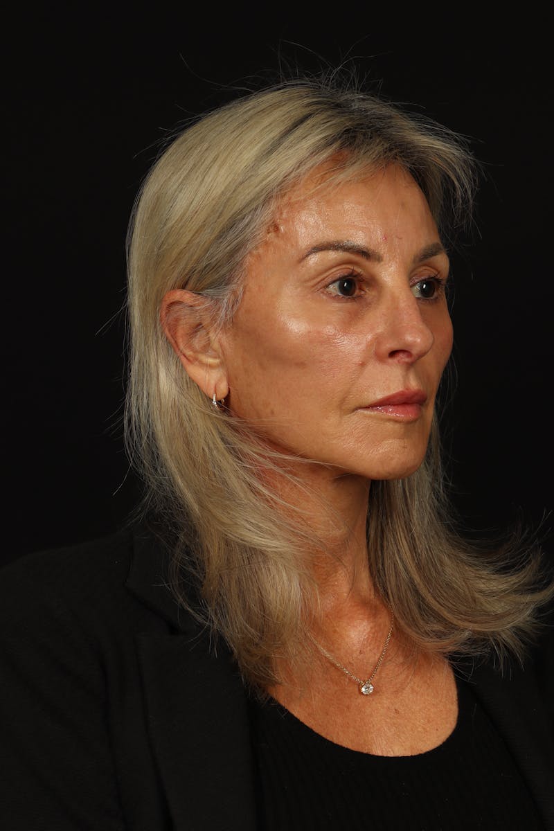 Facelift Before & After Gallery - Patient 246283 - Image 8