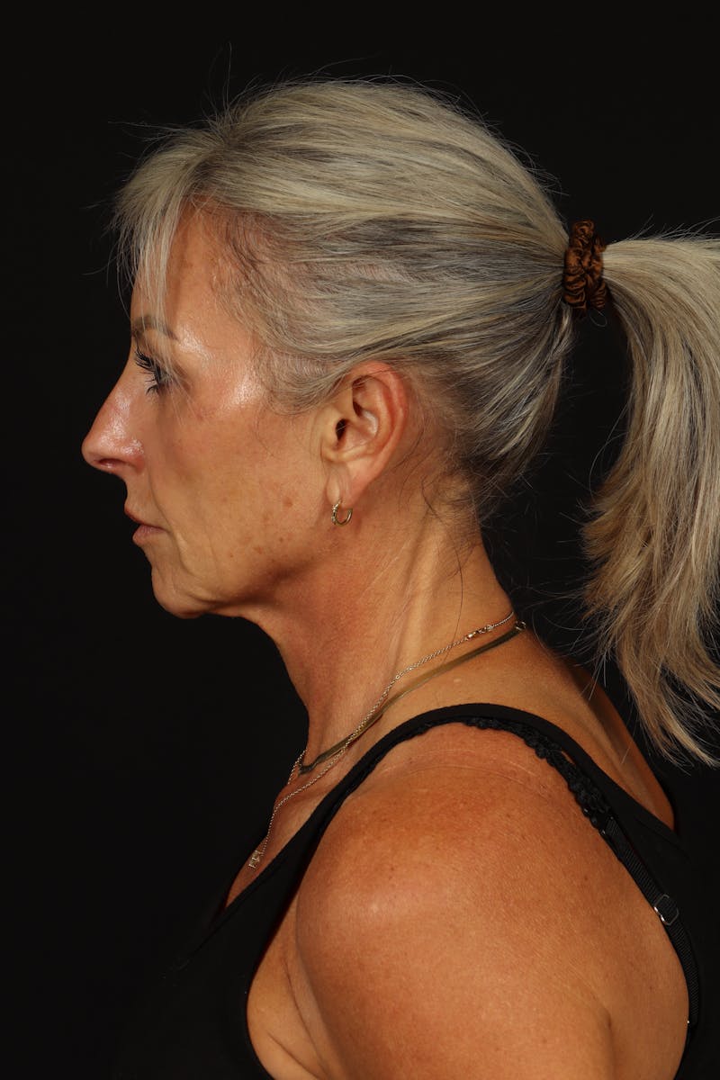 Facelift Before & After Gallery - Patient 246283 - Image 5