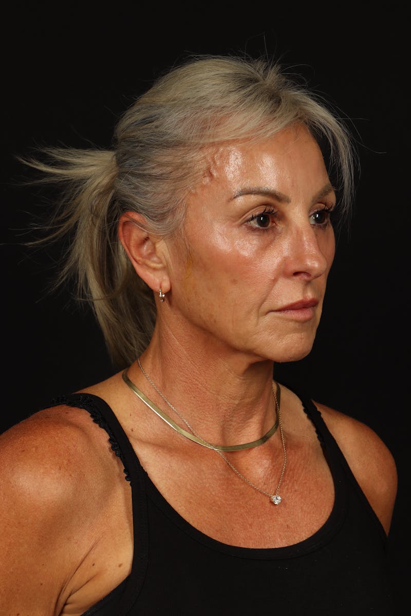 Facelift Before & After Gallery - Patient 246283 - Image 7