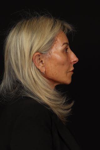 Facelift Before & After Gallery - Patient 246283 - Image 10