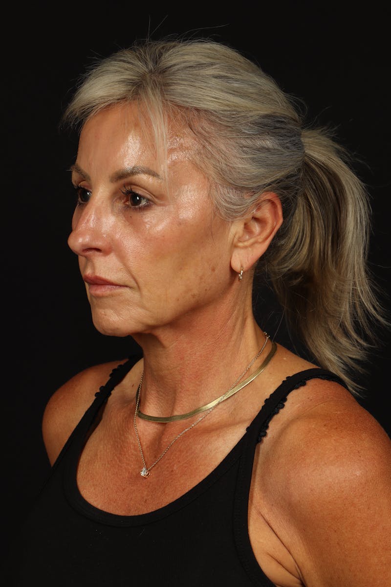 Facelift Before & After Gallery - Patient 246283 - Image 3