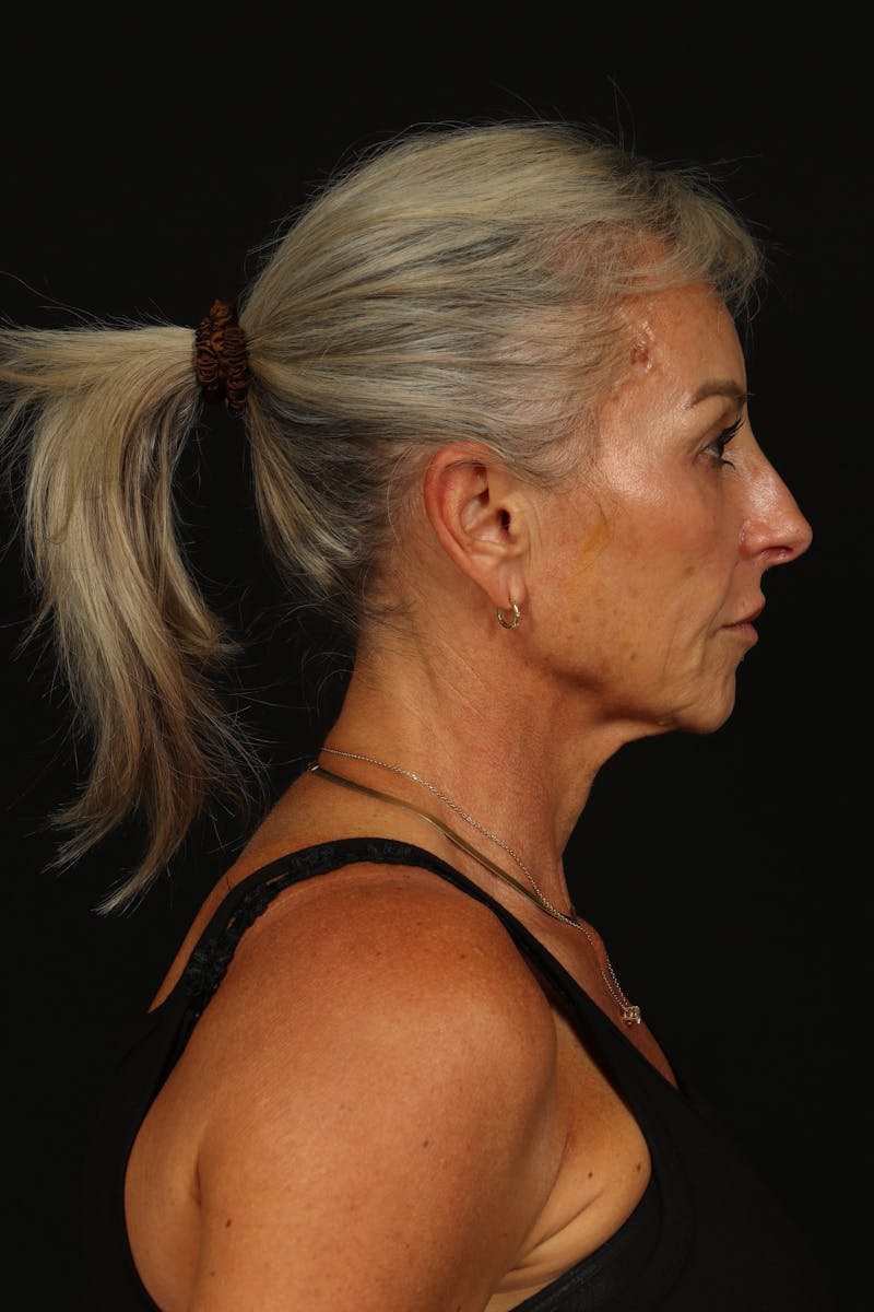 Facelift Before & After Gallery - Patient 246283 - Image 9