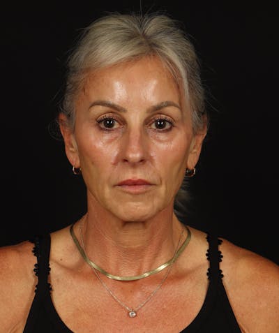 Facelift Before & After Gallery - Patient 246283 - Image 1