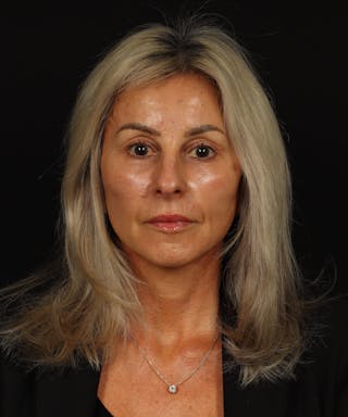 Facelift Before & After Gallery - Patient 246283 - Image 2