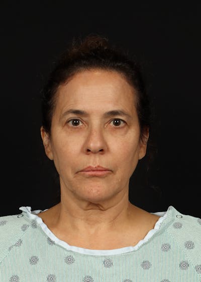 Facelift Before & After Gallery - Patient 343131 - Image 1