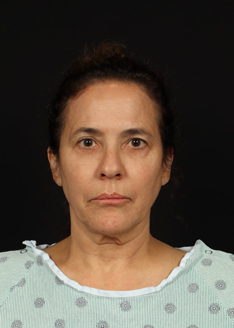 Facelift Before & After Gallery - Patient 343131 - Image 1