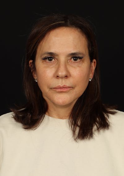 Facelift Before & After Gallery - Patient 343131 - Image 2