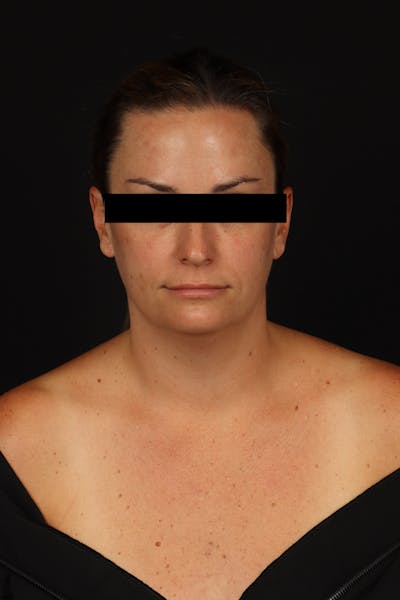 Necklift Before & After Gallery - Patient 870609 - Image 1