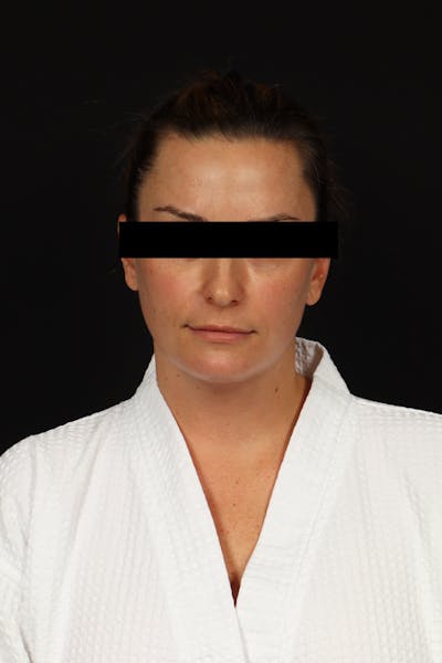 Necklift Before & After Gallery - Patient 870609 - Image 2