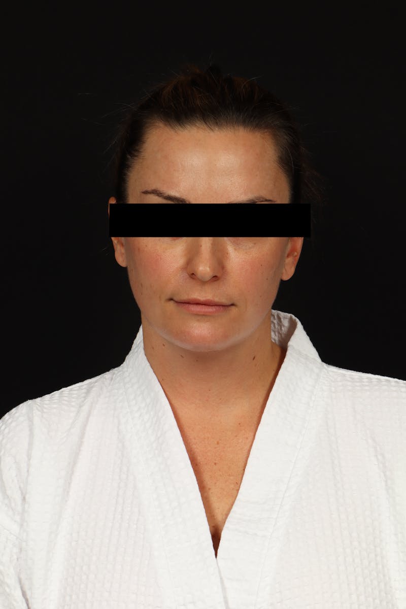 Necklift Before & After Gallery - Patient 870609 - Image 2
