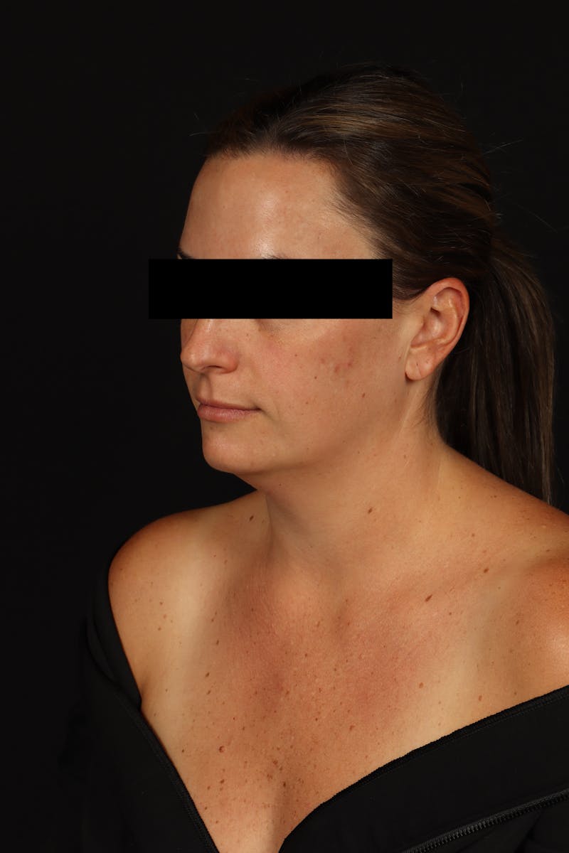 Necklift Before & After Gallery - Patient 870609 - Image 3