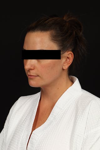 Necklift Before & After Gallery - Patient 870609 - Image 4