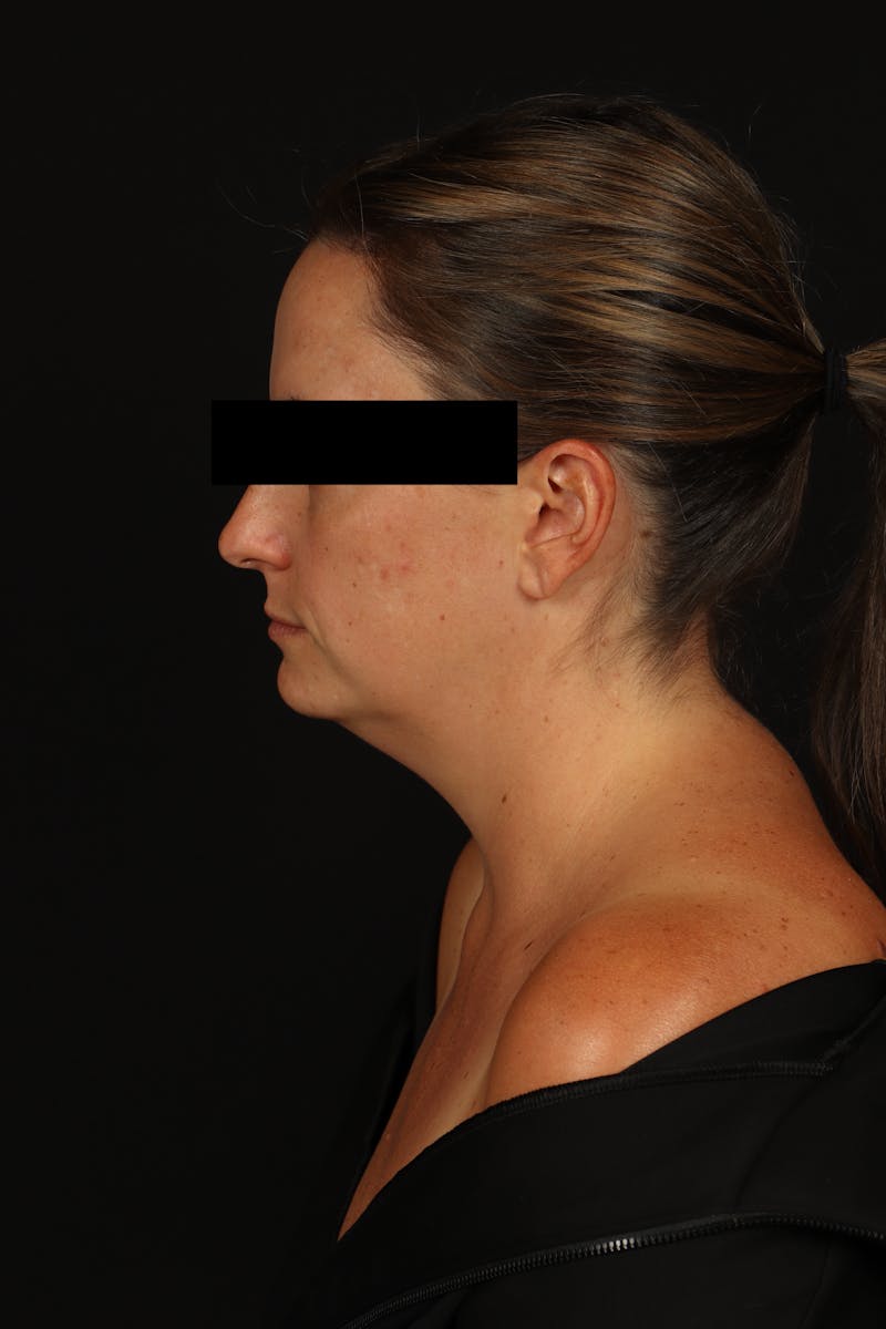 Necklift Before & After Gallery - Patient 870609 - Image 5