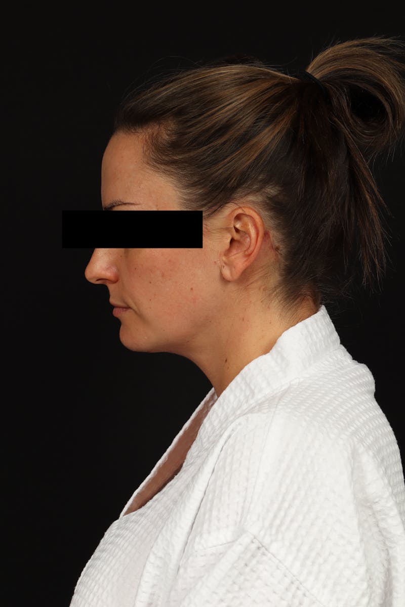 Necklift Before & After Gallery - Patient 870609 - Image 6
