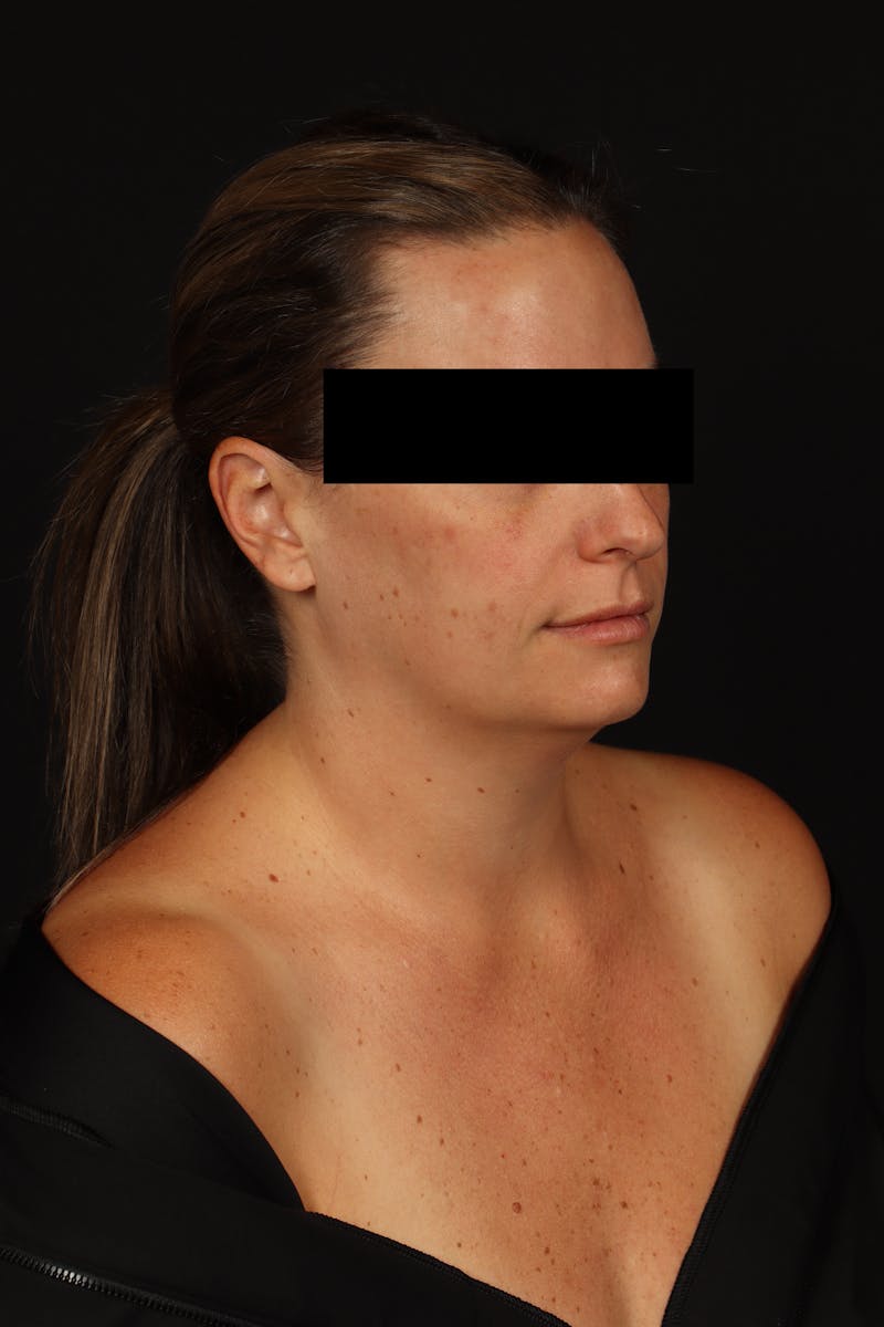 Necklift Before & After Gallery - Patient 870609 - Image 7