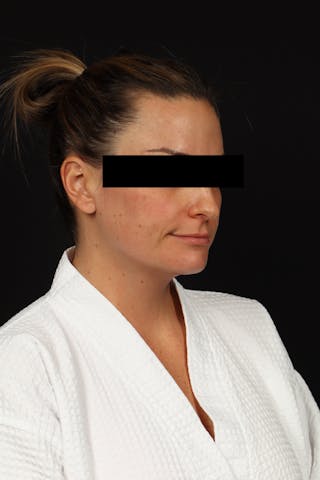 Necklift Before & After Gallery - Patient 870609 - Image 8