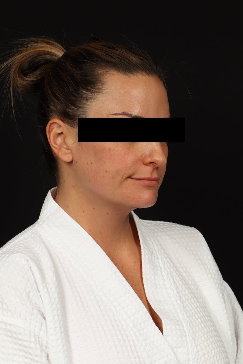 Necklift Before & After Gallery - Patient 870609 - Image 8