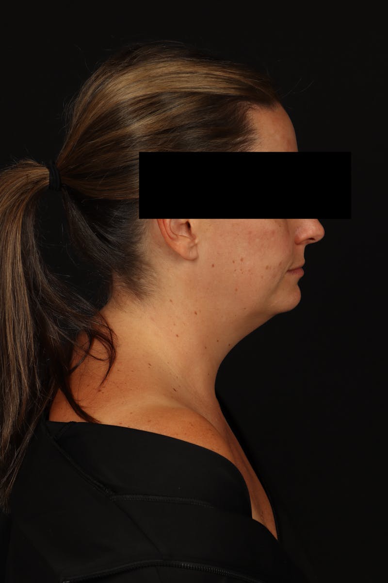 Necklift Before & After Gallery - Patient 870609 - Image 9