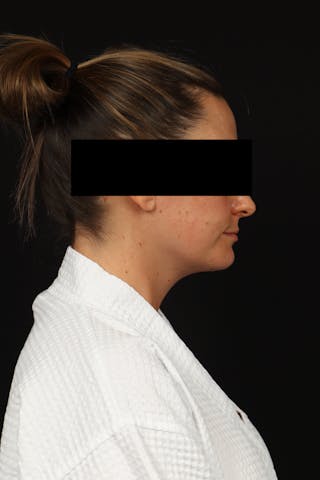 Necklift Before & After Gallery - Patient 870609 - Image 10