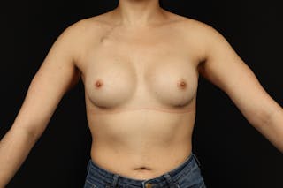 Breast Augmentation Silicone Gel Before & After Gallery - Patient 308985 - Image 2