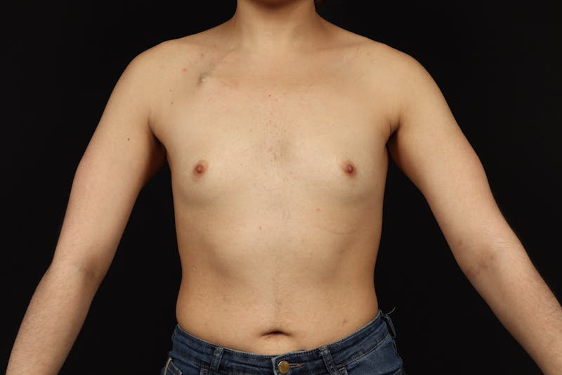 Breast Augmentation Silicone Gel Before & After Gallery - Patient 308985 - Image 1