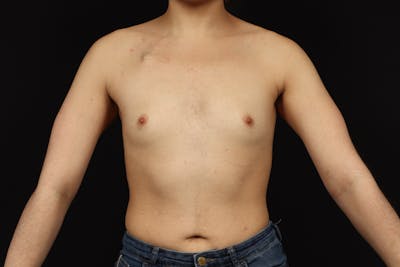 Breast Augmentation Silicone Gel Before & After Gallery - Patient 308985 - Image 1