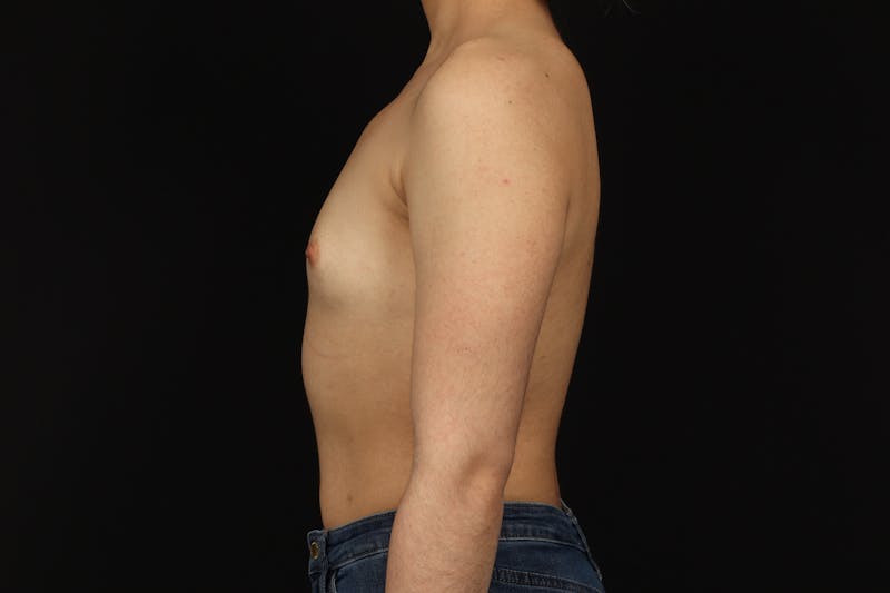 Breast Augmentation Silicone Gel Before & After Gallery - Patient 308985 - Image 5