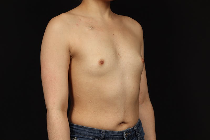 Breast Augmentation Silicone Gel Before & After Gallery - Patient 308985 - Image 7