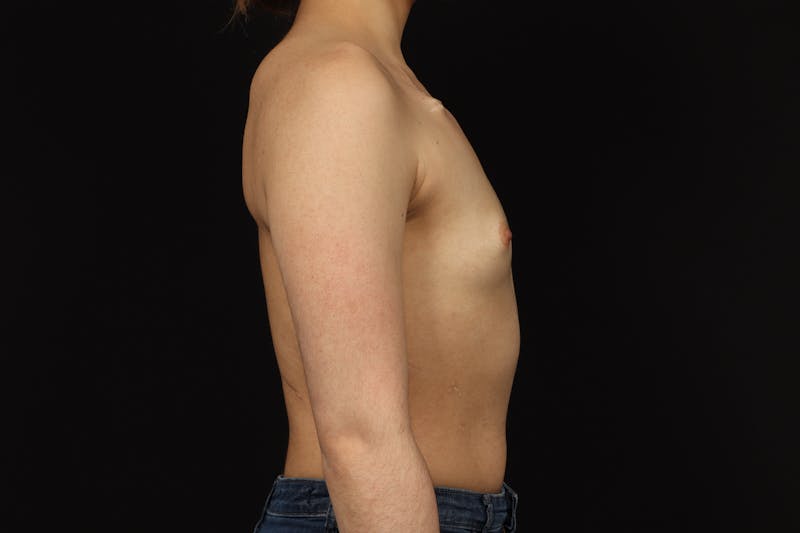 Breast Augmentation Silicone Gel Before & After Gallery - Patient 308985 - Image 9