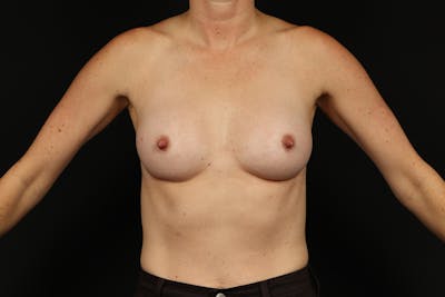 Breast Augmentation Silicone Gel Before & After Gallery - Patient 383012 - Image 2