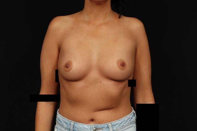 Breast Augmentation Silicone Gel Before & After Gallery - Patient 805979 - Image 1