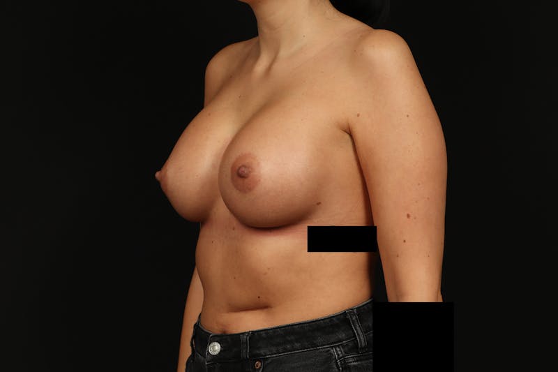 Breast Augmentation Silicone Gel Before & After Gallery - Patient 805979 - Image 4