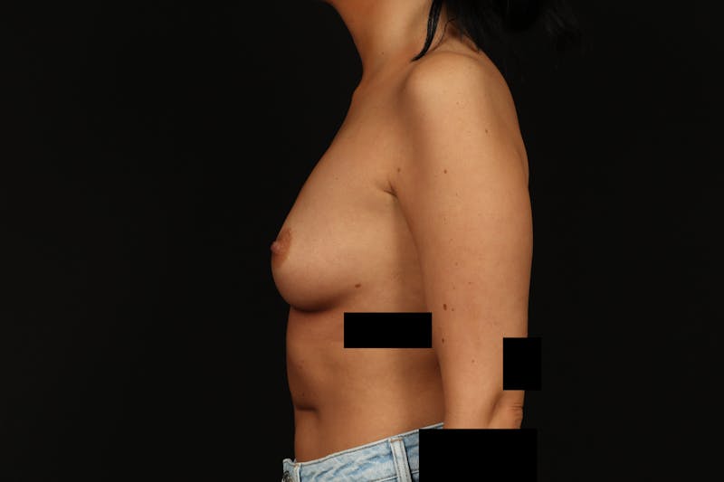 Breast Augmentation Silicone Gel Before & After Gallery - Patient 805979 - Image 5