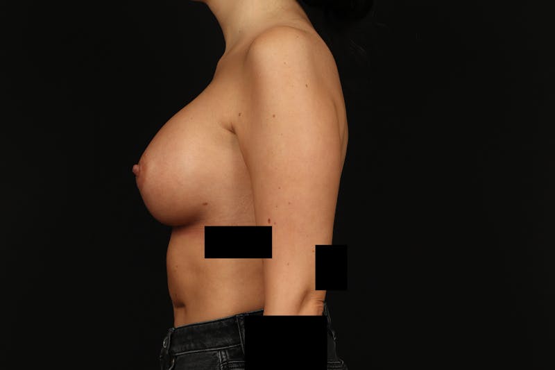 Breast Augmentation Silicone Gel Before & After Gallery - Patient 805979 - Image 6