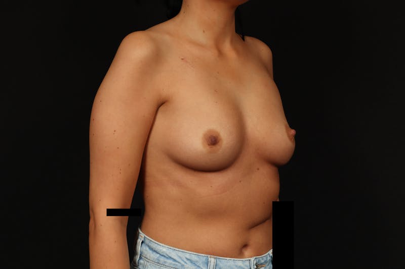 Breast Augmentation Silicone Gel Before & After Gallery - Patient 805979 - Image 7