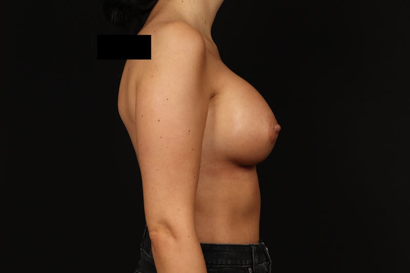 Breast Augmentation Silicone Gel Before & After Gallery - Patient 805979 - Image 10
