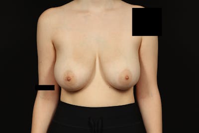 Breast Reduction Before & After Gallery - Patient 416022 - Image 1