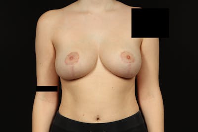 Breast Reduction Before & After Gallery - Patient 416022 - Image 2