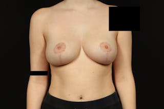 Breast Reduction Before & After Gallery - Patient 416022 - Image 2