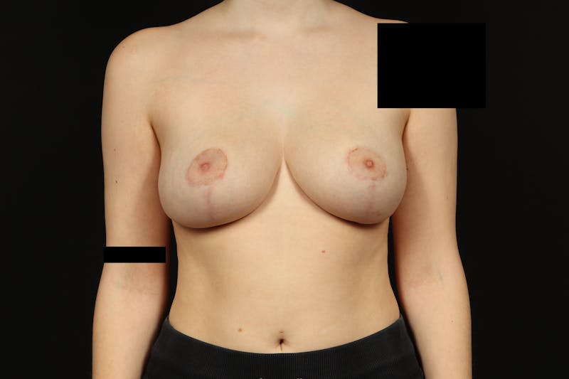 Breast Reduction Before & After Gallery - Patient 416022 - Image 2