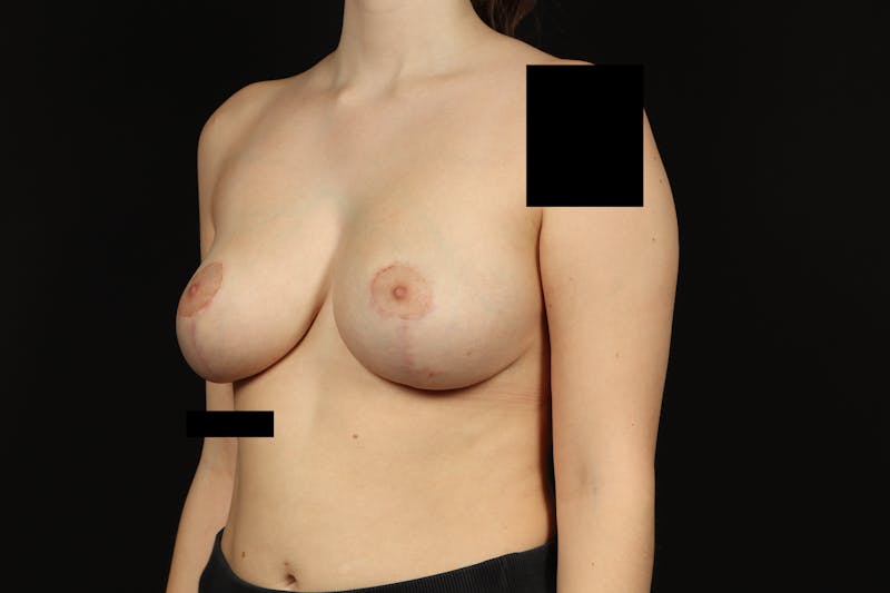 Breast Reduction Before & After Gallery - Patient 416022 - Image 4
