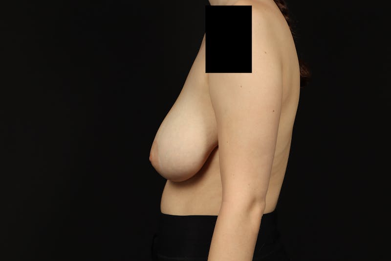 Breast Reduction Before & After Gallery - Patient 416022 - Image 5