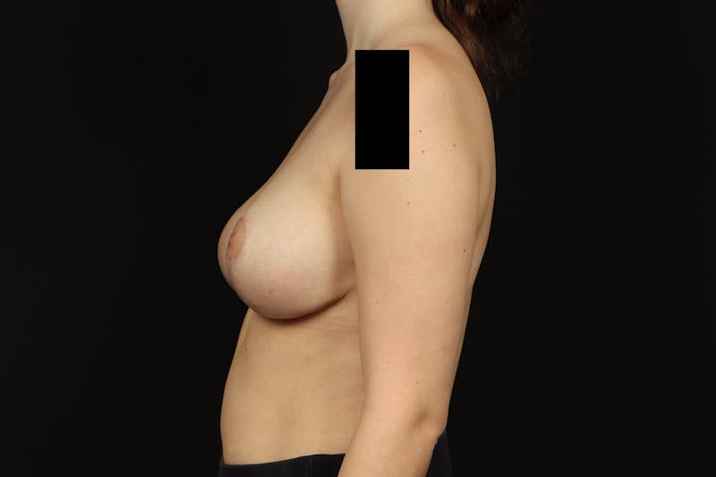 Breast Reduction Before & After Gallery - Patient 416022 - Image 6