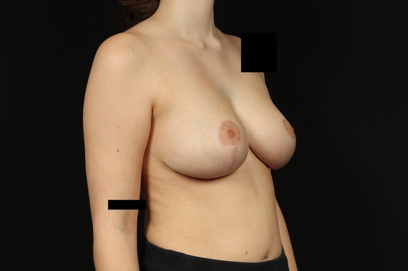 Breast Reduction Before & After Gallery - Patient 416022 - Image 8