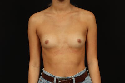 Breast Augmentation Silicone Gel Before & After Gallery - Patient 215580 - Image 1