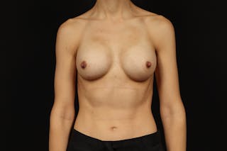 Breast Augmentation Silicone Gel Before & After Gallery - Patient 288442 - Image 2