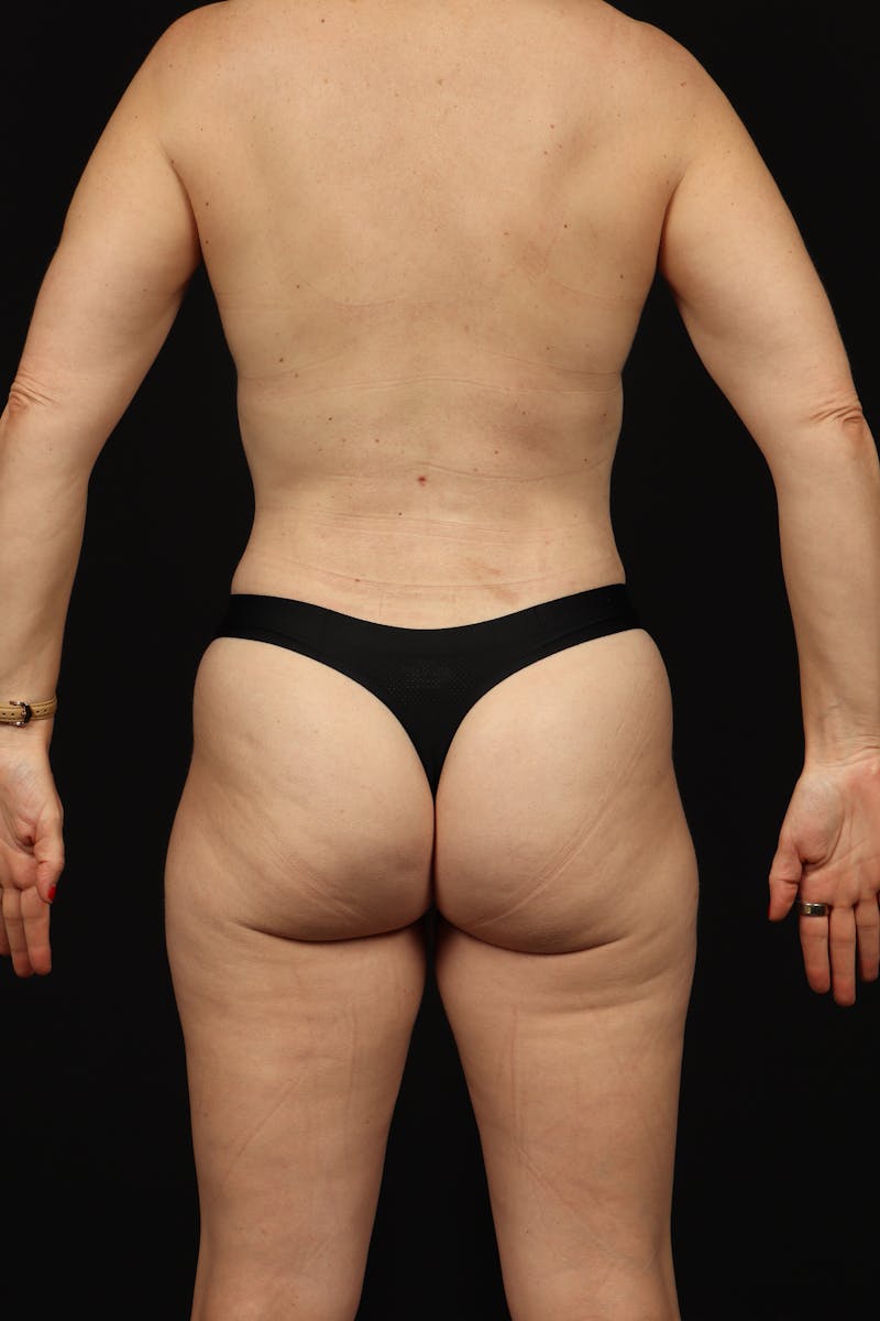 Mommy Makeover Before & After Gallery - Patient 299032 - Image 12