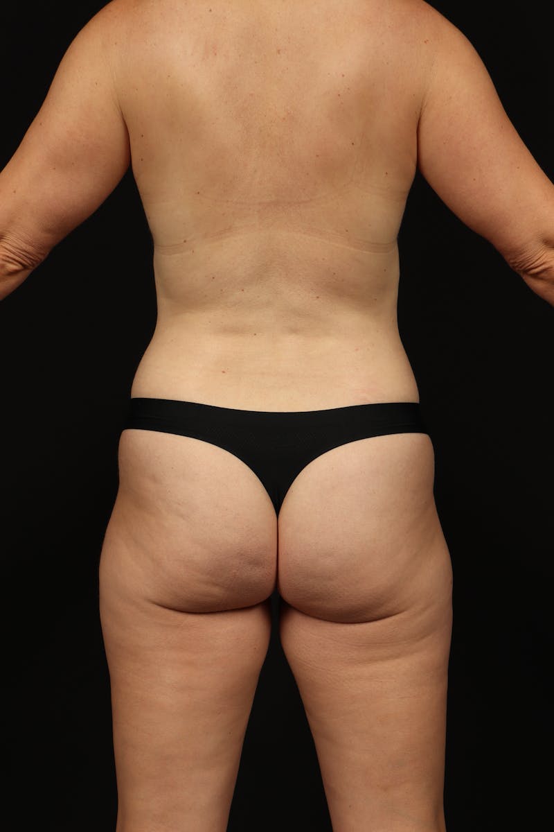 Mommy Makeover Before & After Gallery - Patient 299032 - Image 11