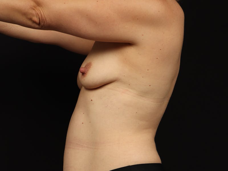 Mommy Makeover Before & After Gallery - Patient 299032 - Image 5