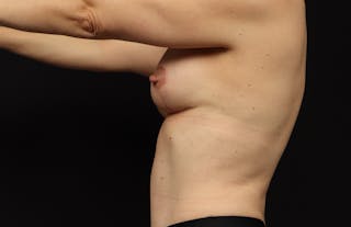 Mommy Makeover Before & After Gallery - Patient 299032 - Image 6